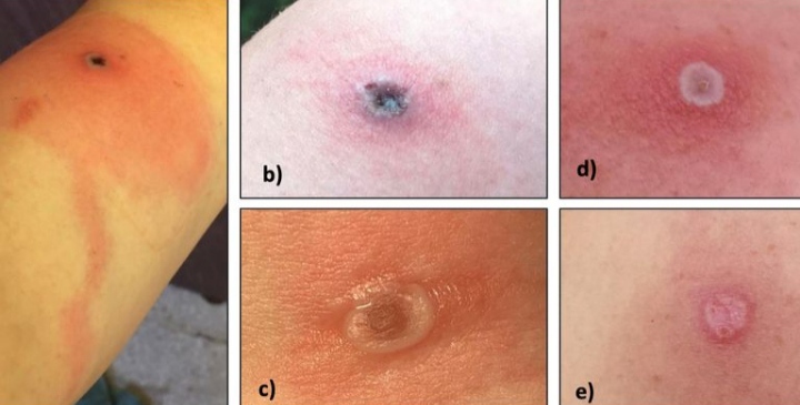 Alaskapox, a Zoonotic Virus, Emerges in Alaska - Seven Cases Reported, one dies.